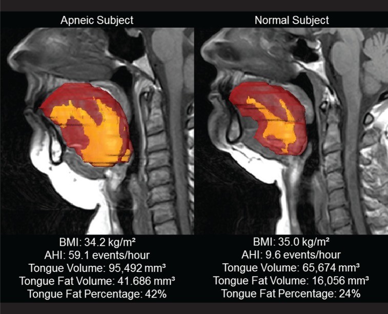 X-ray of person with sleep apnea