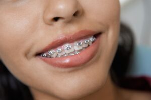 Dental Plans for Orthodontia Coverage