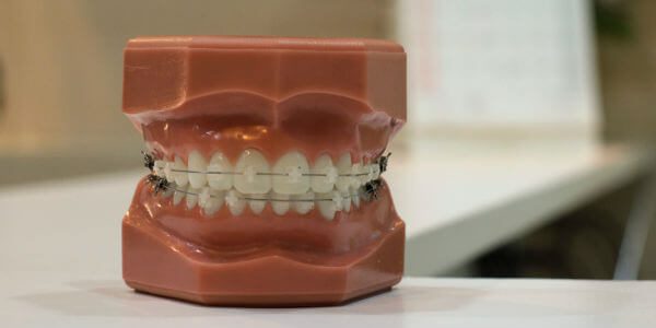 Orthodontics in Singapore and your dental insurance