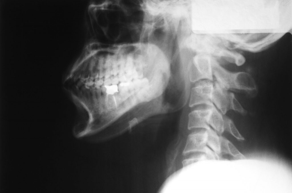 X-Ray of the Neck