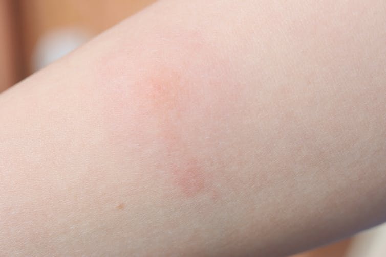 Red skin reaction resulting from a mosquito bite