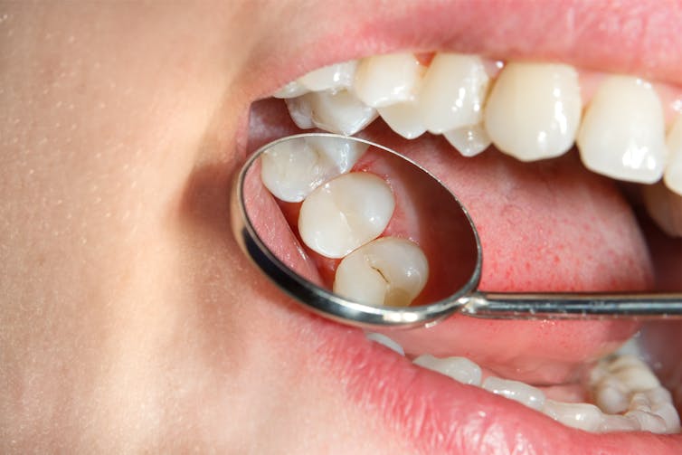 Close-up of dental mirror in someone's mouth looking at decay in tooth.