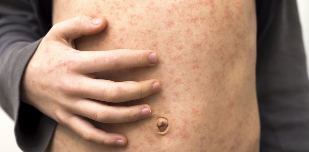 Texas records first US measles death in 10 years – a medical epidemiologist explains how to protect yourself and your community from this deadly, preventable disease